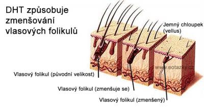 DHT způsobuje zmenšování folikulů a vypadávání vlasů dht vypadávání vlasů androgenní alopecie u mužů a žen